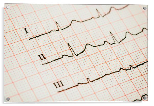Sinus Heart Rhythm On Electrocardiogram Paper Acrylic by Radu Bercan